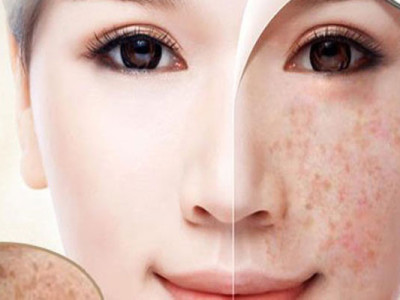 (Top) 7 kem trị nám của Mỹ tốt nhất hiện nay