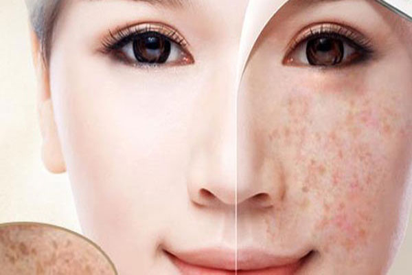 Làm thế nào để sử dụng collagen trị nám của Mỹ hiệu quả nhất?
